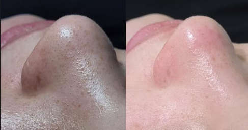 Hidrofacial en Adrogué