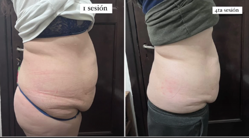 Liposonix en Adrogué