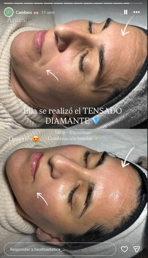 Antes y después tratamiento HIFU en Adrogué